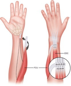 Tendon Transfer Surgery | Dr. Chaitanya Karande