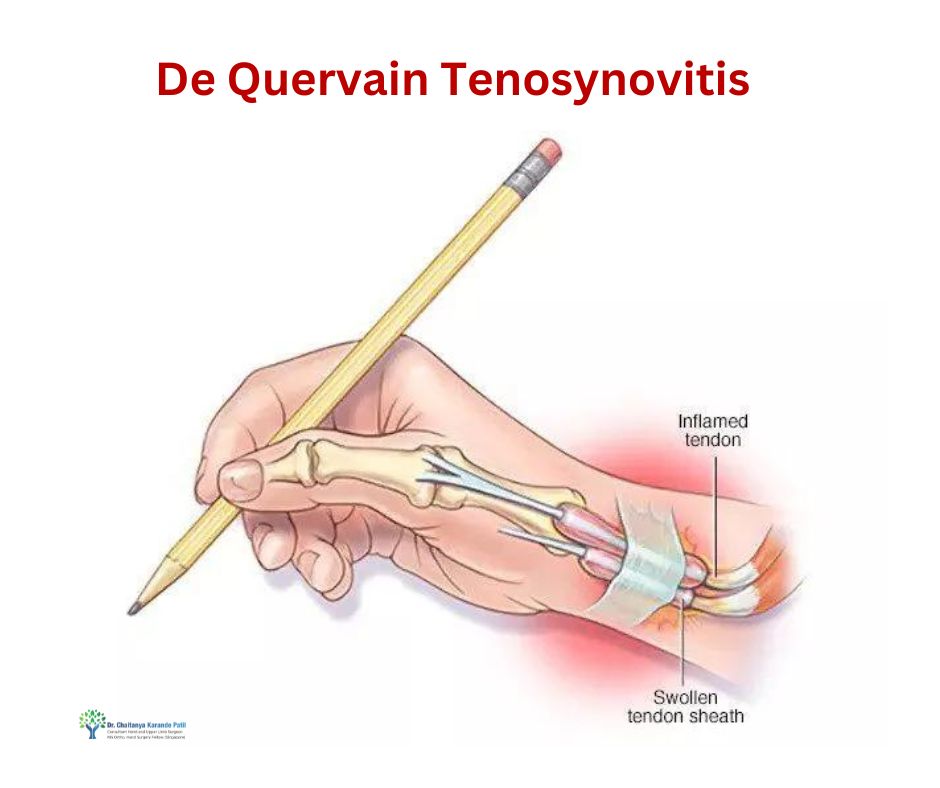 De Quervain tenosynovitis Treatment in Pune