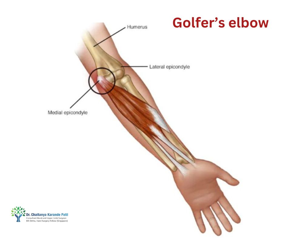 Golfer’s elbow | Hand Surgeon in Pune | Dr. Chaitanya Karande