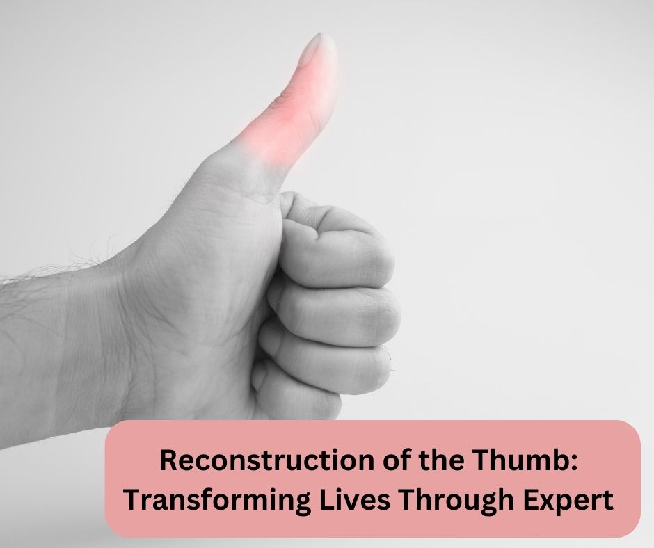 Reconstruction of the Thumb: Transforming Lives Through Expert