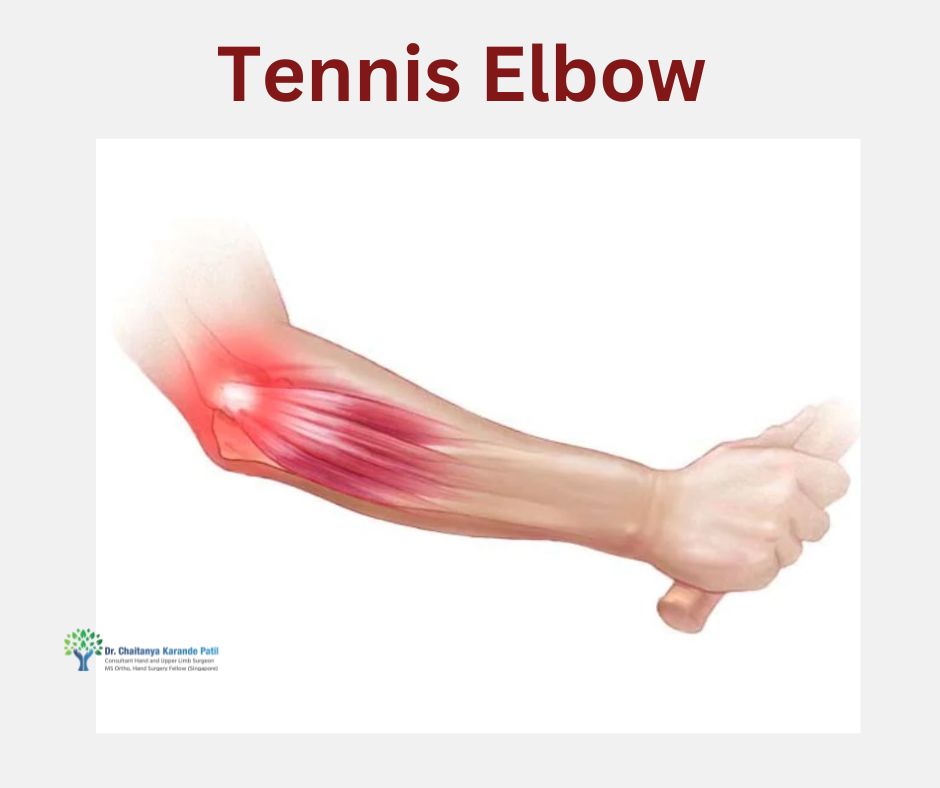 Tennis Elbow Treatment in Pune | Tenosynovitis | Dr. Karande