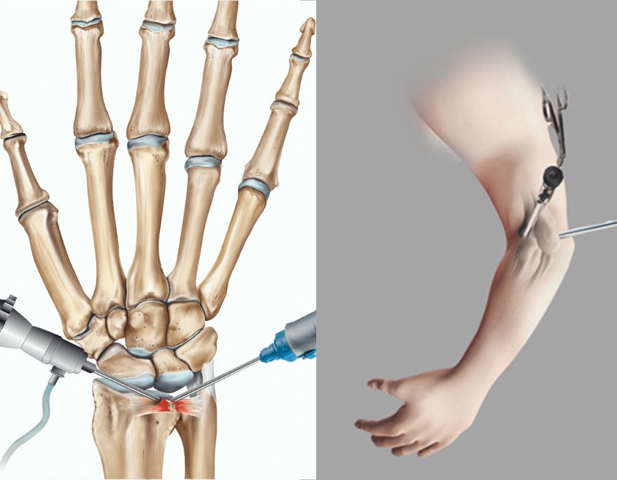 Arthroscopy Of Wrist And Elbow | Hand surgeon | Dr. Chaitanya Karande