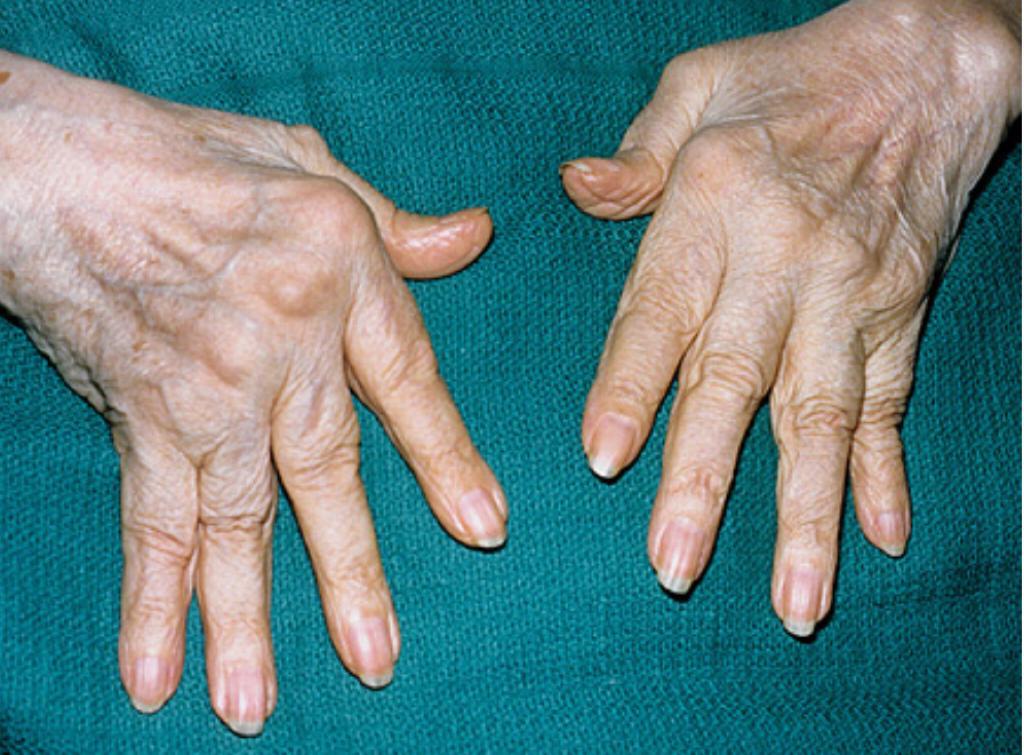 Rheumatoid Arthritis treatment in Pune | Dr. Chaitanya Karande