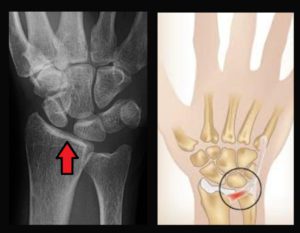 Commonly injured ligaments of the wrist | Hand Surgeon | Dr. Chaitanya Karande