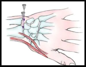 hand injuries | Treatment options | Dr. Chaitanya Karande