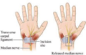 How is carpel tunnel syndrome treated | Dr. Chaitanya Karande