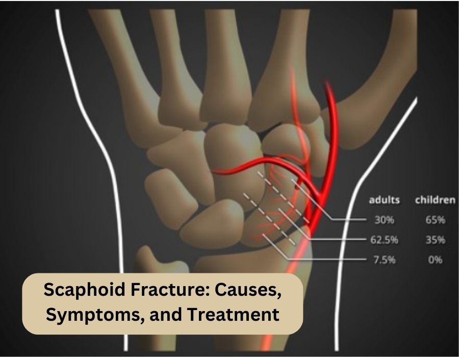 Scaphoid Fracture: Causes, Symptoms, and Treatment | Dr. Chaitanya Karande