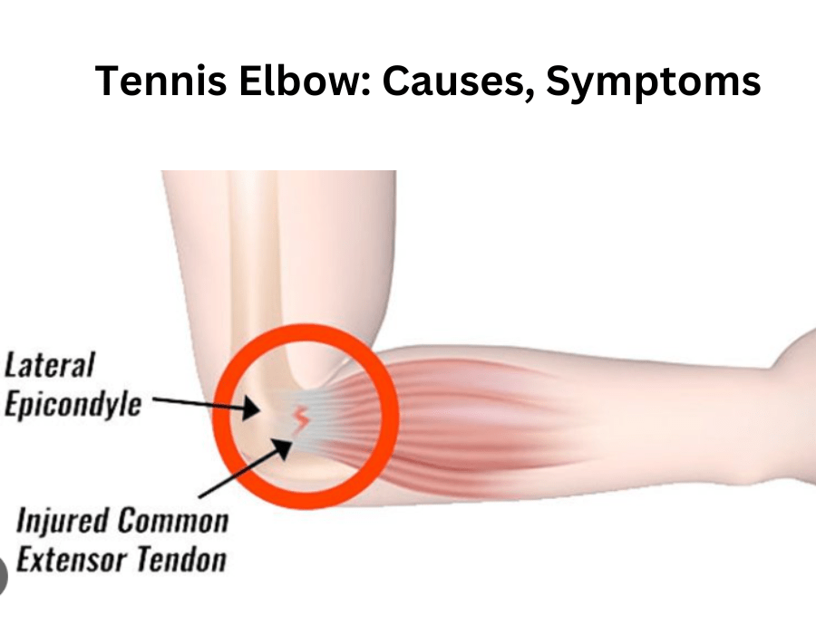 Tennis Elbow: Causes, Symptoms, and Treatment Options