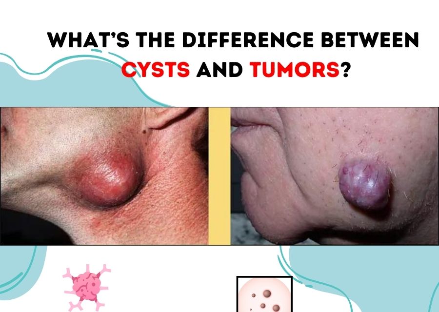 What’s the Difference Between Cysts and Tumors?