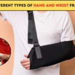 Hand Surgeon in Pune | Wrist fracture surgeons in Pune |the Different Types of Hand and Wrist Fractures